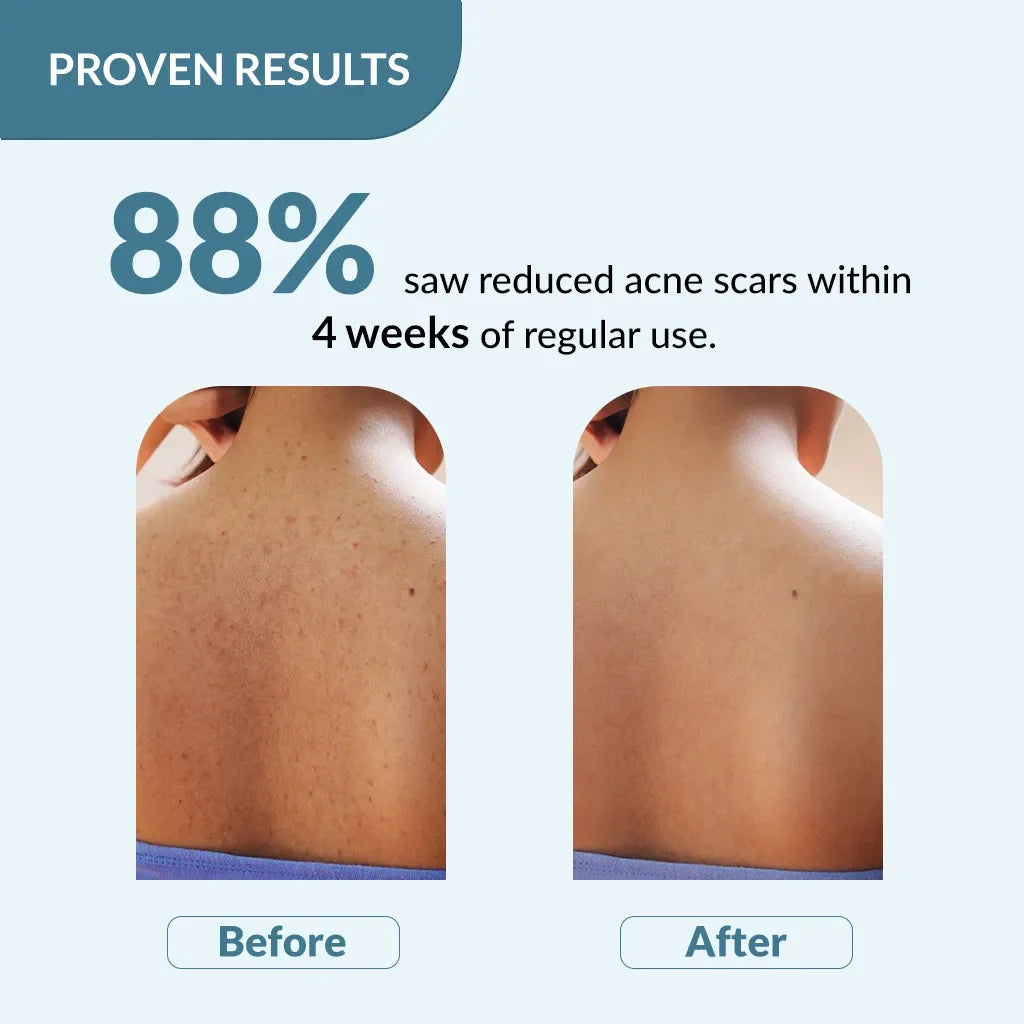 Salyzap Body Wash | Soap-Free Wash to Combat Stubborn Body Acne - Doorderma