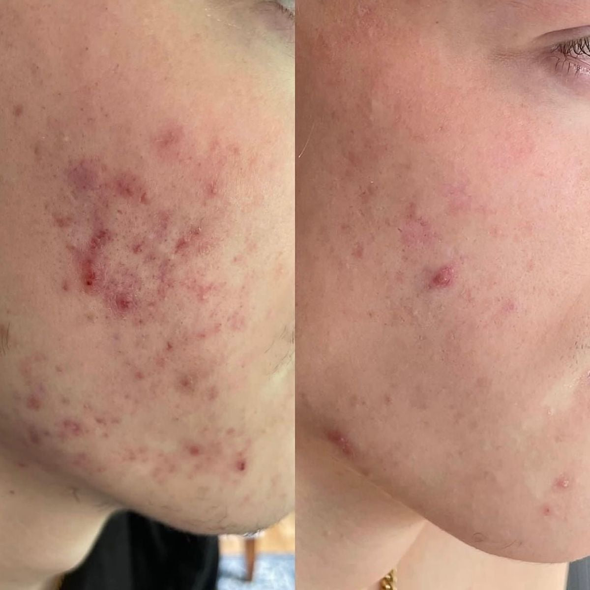 Doorderma Azelaic Face Serum with Probiotic, Ceramides & Cica – 40 ml