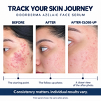Doorderma Azelaic Face Serum with Probiotic, Ceramides & Cica – 40 ml