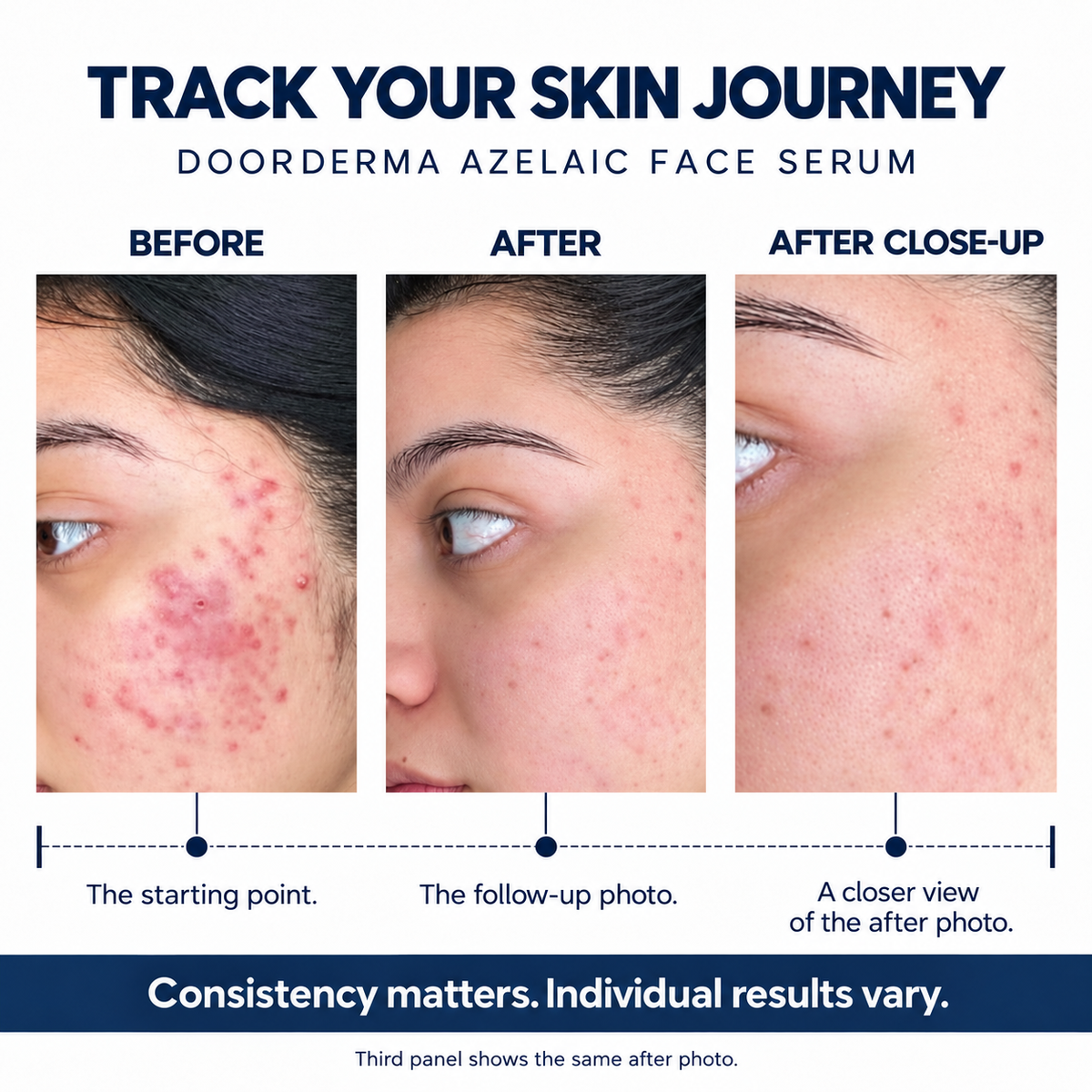 Doorderma Azelaic Face Serum with Probiotic, Ceramides & Cica – 40 ml