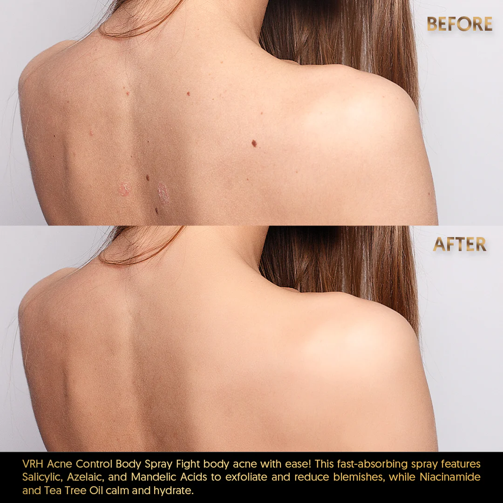 VRH ACNE BODY SPRAY 50ML | Triple Acid Blend with Salicylic, Azelaic & Mandelic Acids | 50ml